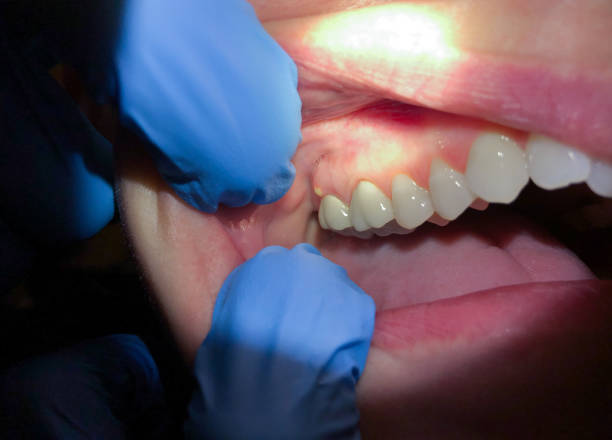 Best Emergency Dental Care for Abscessed Tooth in Hayfield, VA